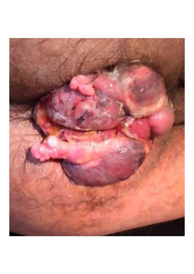 Giant haemorrhoid, approximately 12 cm, prior to surgery